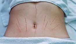 埋线减肥视频全过程,埋线减肥全过程揭秘